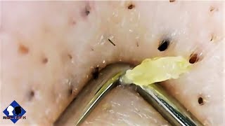 blackheads removal close up part6 [upl. by Misab]