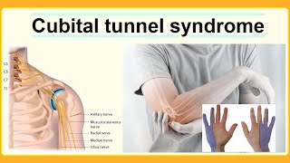 cubital tunnel syndrome [upl. by Feinberg462]