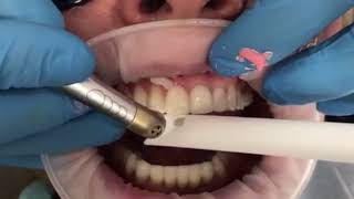 Quick and Pain free veneer removal using Waterlase laser [upl. by Romina]