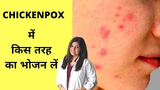 Best Foods For Chickenpox चिकन पॉक्स में किस तरह का खाना खाएं [upl. by Sheldon512]