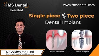 Single Piece vs Two Piece Dental Implants  Dr Dushyanth Paul  FMS Dental Hospitals [upl. by Afital226]