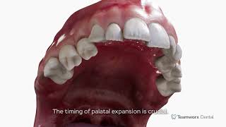 Palatal Expansion [upl. by Nylatsirhc753]