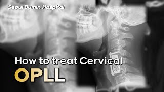 How to treat cervical OPLL [upl. by Runkle]