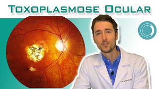 Toxoplasmose ocular  tratamento [upl. by Sihtnyc]