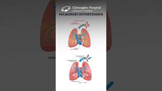 All About Pulmonary Arterial Hypertension Symptoms and Detection  Gleneagles Hospital [upl. by Leonie]