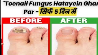 quotToenail Fungus Ka Permanent Ilaj  Try These Gharelu Nuskhequot [upl. by Michal560]