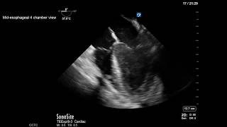 Transesophageal Echocardiography Management of ECMO [upl. by Vittoria]