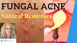 FUNGAL ACNE  MALASSEZIA FOLLICULITIS  NATURAL REMEDIES [upl. by Yalcrab]