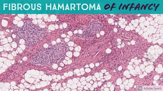 Fibrous Hamartoma of Infancy [upl. by Elenahc]