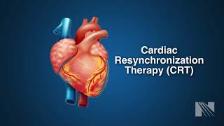 Ventricular Fibrillation Treatment Cardiac Resyncrhoniation Therapy CRT [upl. by Raquela]