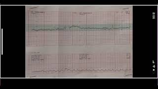 Monitoreo fetal [upl. by De Witt699]