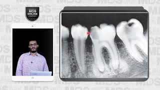 2 Periapical inflammatory lesions [upl. by Kindig]