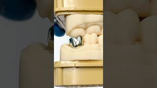 Gold Molar EnvisiontecMain envisiontec lsk121shorts dentist teeth [upl. by Ymer]