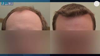 FUE 2991 Fu´s Dr Lupanzula MeDiKemos ENG hairtransplant [upl. by Itin]