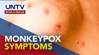 What you need to know about monkeypox symptoms [upl. by Placia]