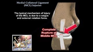 Medial Collateral Ligament Injuries  Everything You Need To Know  Dr Nabil Ebraheim [upl. by Krever]