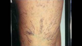 Varicose Veins Treatment [upl. by Hesoj]