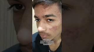 acne pimple pimpletreatment pimplesolution highlights drf raza [upl. by Inait744]