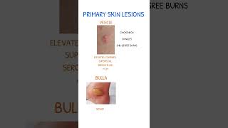 SKIN LESIONS Vesicle Vs Bulla [upl. by Yltnerb]