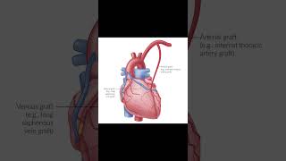 CABGCoronary artery bypass grafting [upl. by Lauer]