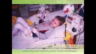 Epidermolysis Bullosa EB Awareness video extended [upl. by Christoph]