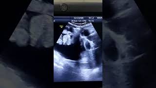 Liver Cirrhosis Ascites with floating Bowel loopsshorts [upl. by Akcirred876]