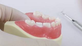 Pediatric Zirconia Crown Technique  Posterior [upl. by Htial]