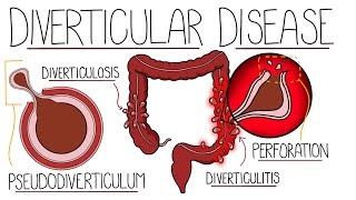 Understanding Diverticular Disease Diverticulosis and Diverticulitis [upl. by Brear]