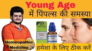 Young Age मैं पिंपल्स की समस्या  Homeopathic medicine  Asterias Rubens  how to use  symptoms [upl. by Ahtebbat686]