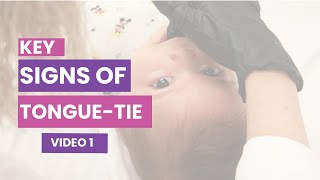 How To Tell If Your Baby Has A Tongue Tie  Key Signs Every Parent Should Know [upl. by Diego]