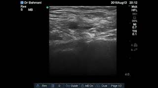 Case 189  Inguinal Lymph Nodes Ultrasound [upl. by Neiviv]