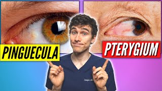 Pinguecula Vs Pterygium Signs Symptoms Treatment [upl. by Aztilay]