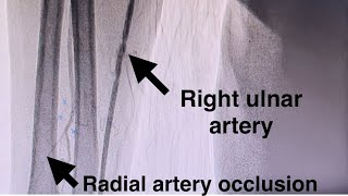 How To Puncture The Ulnar Artery in Ipsilateral Radial Artery Occlusion Anterior Puncture Technique [upl. by Nehte406]