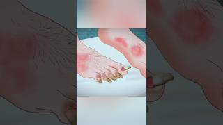 ASMR Toe Treatment  2D Animation Surgery 2danimation treatment surgery asmr shorts viral [upl. by Wiles]