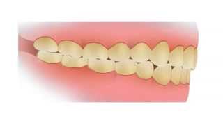 Common Dental Problems Plaque [upl. by Essie]