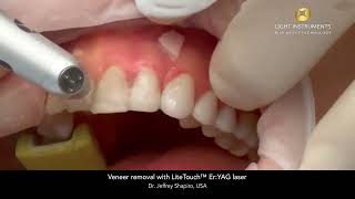 Veneer removal with LiteTouch™ ErYAG laser [upl. by Eniamart975]