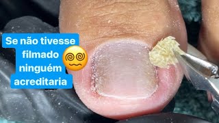 TIREI A MAIOR PELE DEBAIXO DA UNHA QUE JÁ APARECEU NO CANAL INÉDITO 😷 [upl. by Nauqyaj]