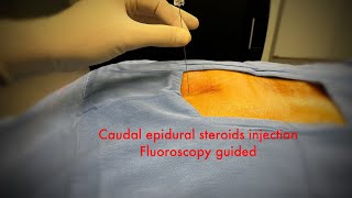 caudal epidural steroids injection fluoroscopystep by step [upl. by Nida]