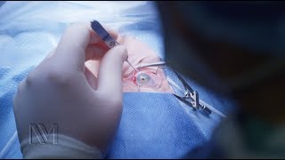 Strabismus Eye Surgery  Inside the OR [upl. by Llabmik]