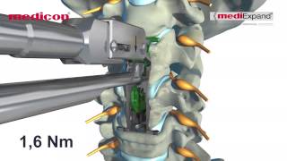 MEDICON  quotmediExpand®quot Cervical [upl. by Pierette]