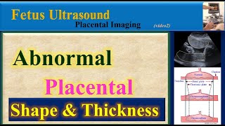 Fetus Ultrasound Abnormal Placental Shape and Thickness [upl. by Elletnwahs768]