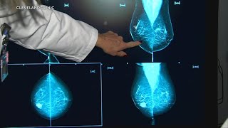 Young women are being diagnosed with breast cancer here is what doctors say [upl. by Nnod]