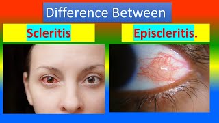 Difference between Scleritis and Episcleritis [upl. by Heddy297]