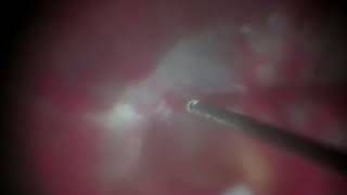 Vitrectomy in a case of PDR [upl. by Nimaynib]