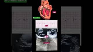 Normal ECG ECHO Angiography  Normal Heart Animation echo  short  video ▶️ [upl. by Welker]