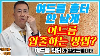 여드름 흉터 안남게 여드름 압출하는 방법 여드름 닥터가 알려드립니다 [upl. by Aiblis]