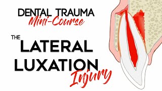 Dental Trauma MiniCourse  Part 9  Dental Trauma Guide  The Lateral Luxation Injury [upl. by Basset132]