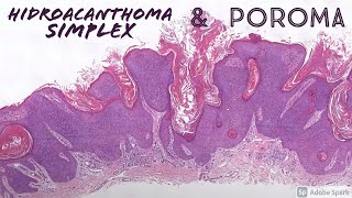 Poroma amp Hidroacanthoma Simplex dermatopathology dermatology pathology sweat gland tumors [upl. by Peer]