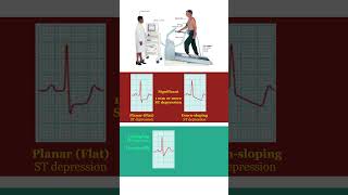 Significant ST change definition in Exercise Testing [upl. by Kelsi799]