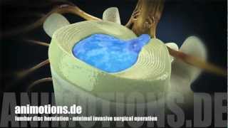 Herniation quotlumbarquot Treatment Surgery 3D Animation [upl. by Ahsayn]